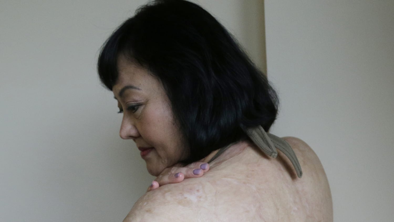 Refreshing News: Napalm Girl Receives Laser Surgery To 