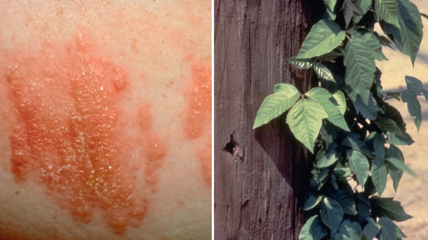 Poison Ivy Rash Treatment & Pictures of Poisonous Plants