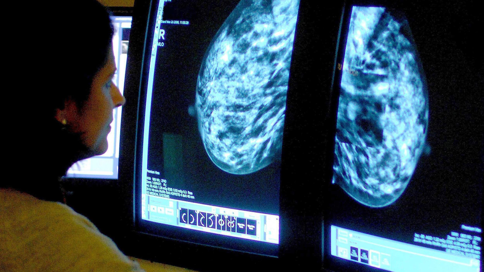 When Should You Get a Mammogram? - NBC News