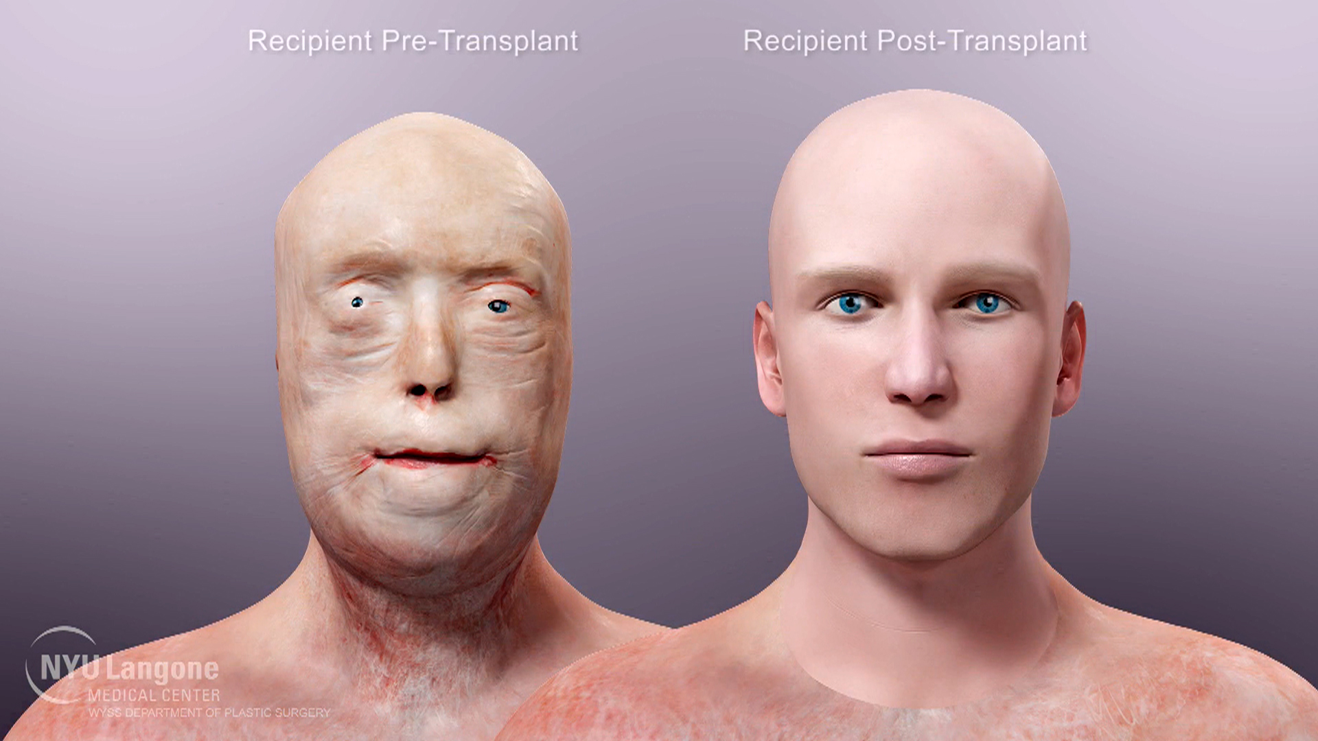 Medical Animation Details Face Transplant Surgery at NYU