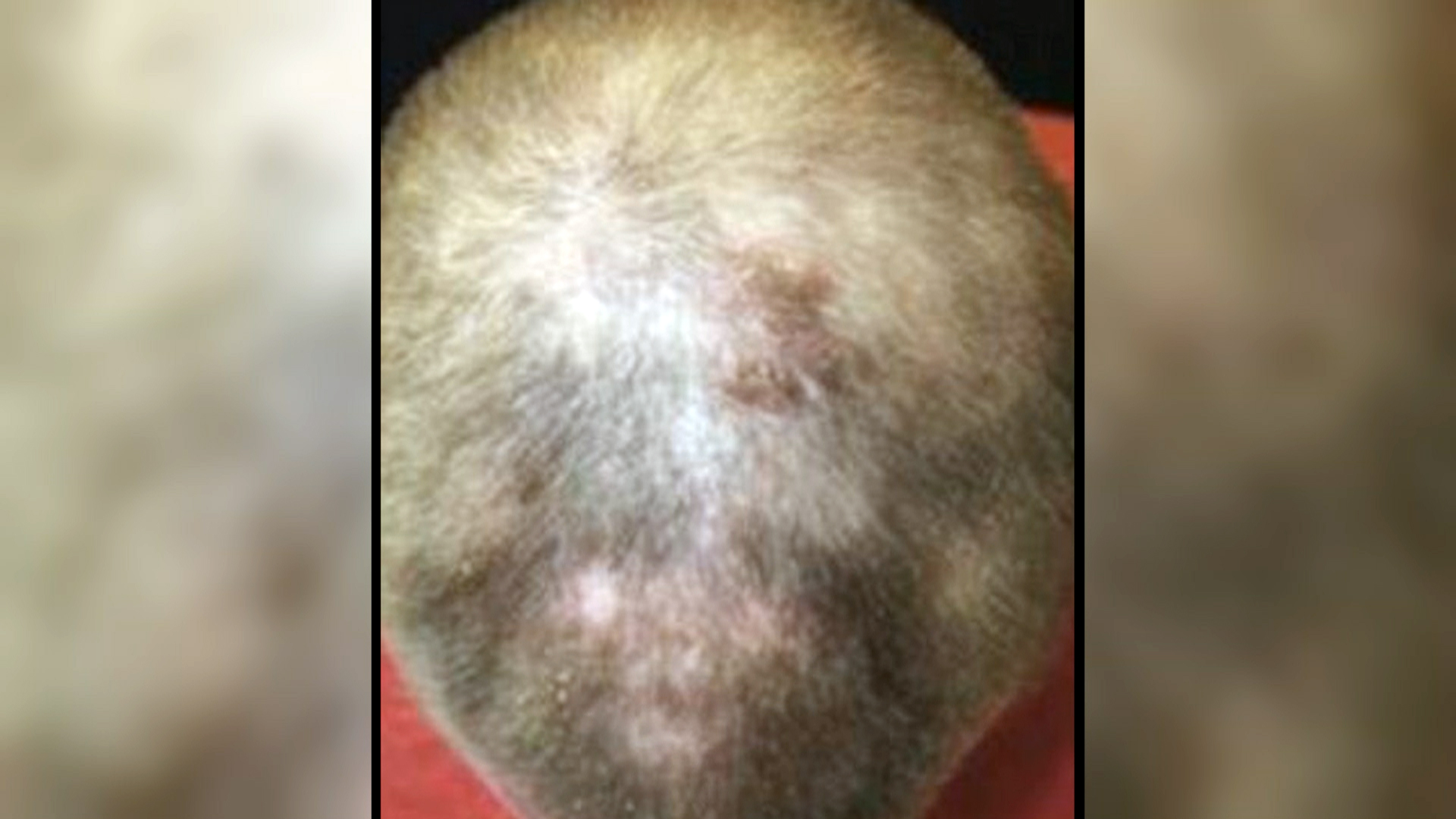 Bald Man Grows Full Head of Hair