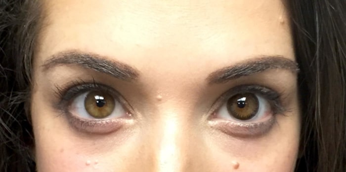 What Are Limbal Rings And Should You Care That They Re Aging