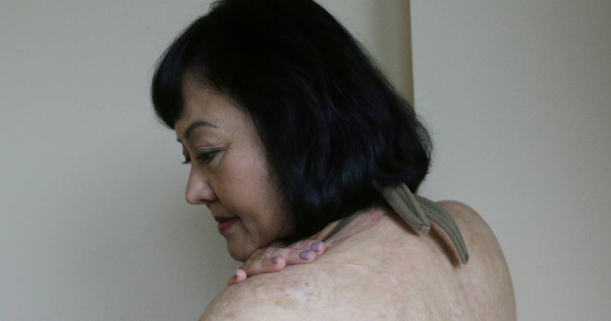 New laser treatment aims to ease pain of Vietnams Napalm 