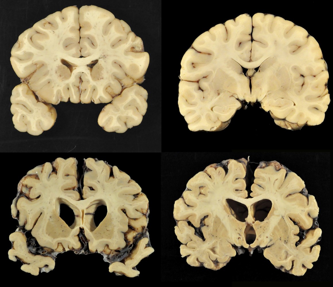 CTE Study Finds Evidence of Brain Disease in 110 Out of ...