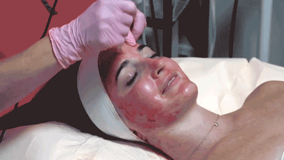 We tried the 'vampire facial' and it was ... bloody