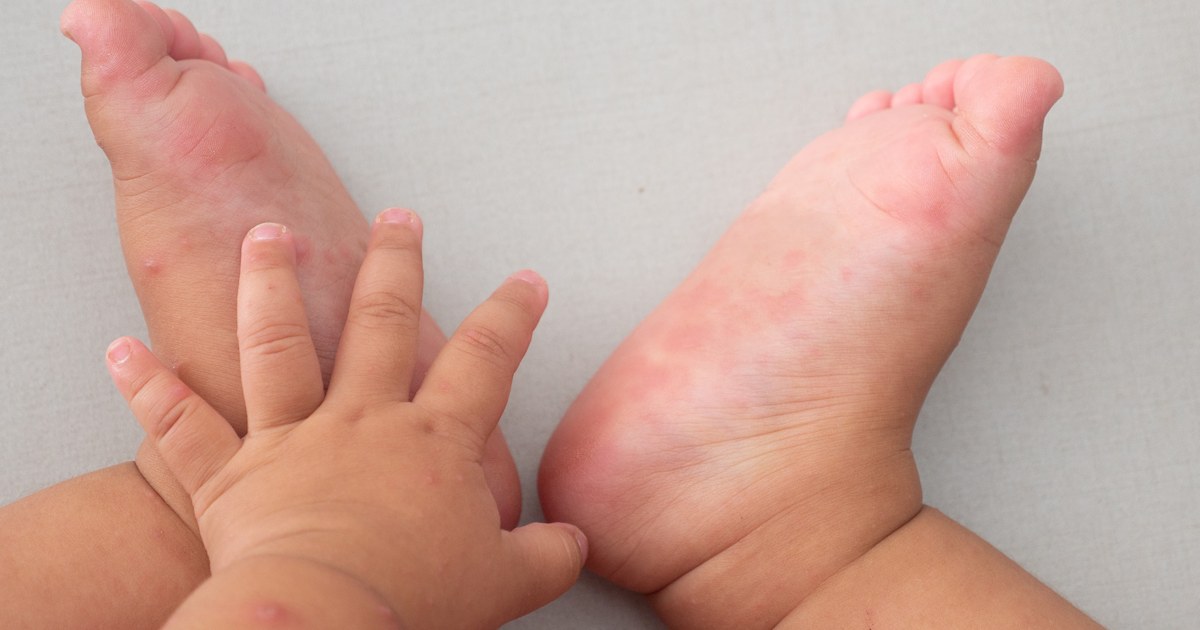Hand, foot and mouth disease: Symptoms, causes and treatments