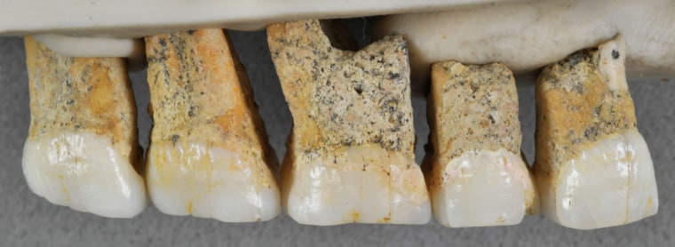 Image: Right upper teeth of an individual of the newly identified species Homo luzonensis, found in Callao Cave on Luzon Island, The Philippines, are seen in this handout photo