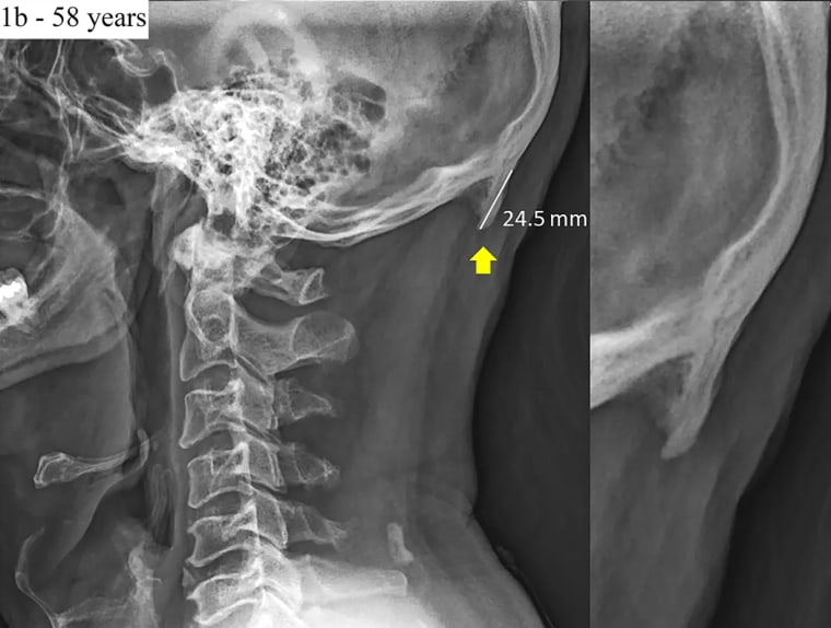 Image: Example of a radiograph of a male 58-year-old presenting with large enthesophytes emanating from the occipital squama.