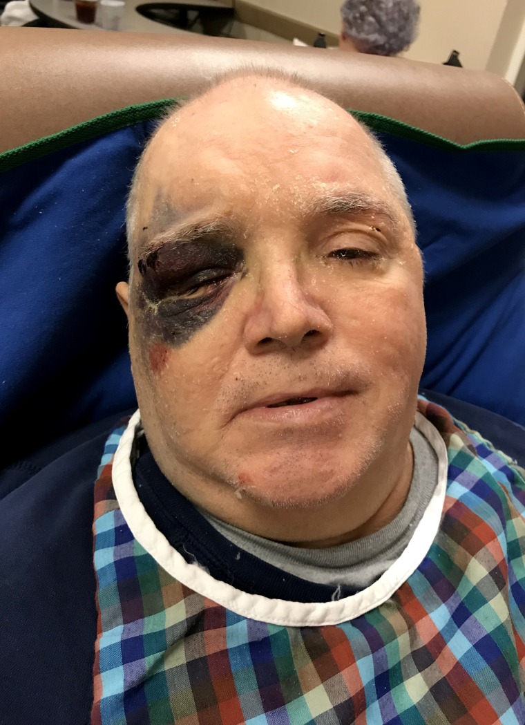 Image: Donny Owens, a resident at a Skyline nursing home in Hazen, Arkansas, fell and bruised his face.  According to his sister Karen Coats, Owens called for staff for 45 minutes before they came to help him.