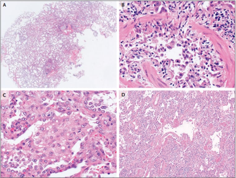These images of lung tissue show severe chemical injuries caused by vaping unknown substances. On the top right is a cross section of a small airway. The pink circular structure is the airway wall. Pathologists explain there should be nothing in the middle of that structure so air can flow easily. Instead, the image shows widespread inflammation and injury, inhibiting oxygen flow. 